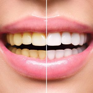 Woman,Teeth,Before,And,After,Whitening.,Happy,Smiling,Woman.,Dental