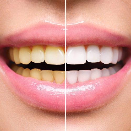 Woman,Teeth,Before,And,After,Whitening.,Happy,Smiling,Woman.,Dental